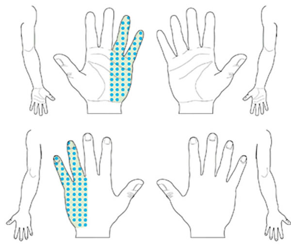 Нетипичный паттерн кистевого туннельного синдрома (онемение, боль, покалывание и снижение чувствительности). Симптомы в 1-м, 2-м или 3-м пальцах отсутствуют.